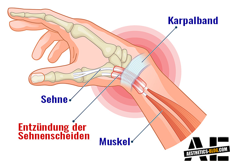 Sehnenscheidenentzündung am Handgelenk